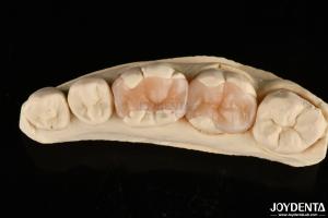 China Natural Polymerized Porcelain Dental Inlay Onlay For Tooth Restoration factory