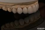 Smooth And Lightweight Dental Veneers Biocompatible And Comfortable For Oral