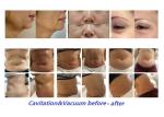 Weight Loss Beauty Treatment Machines Body Tightening Machine 40khz Cavitation
