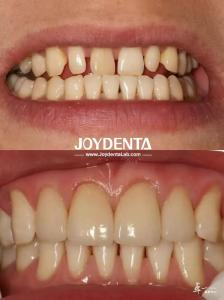 China Long-lasting Dental Veneers No Discoloration Perfect For B2B Sourcing Needs And More factory