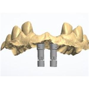 Natural-looking Zirconia Dental Crown with Excellent Biocompatibility and