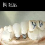 Single Crowns Zirconia Abutment Hypoallergenic Dental Implant Zirconia Abutment
