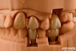 Customizable Implant Crown and Bridge Achieve a Natural Look with Long-lasting