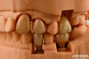 China Customizable Implant Crown and Bridge Achieve a Natural Look with Long-lasting Results factory