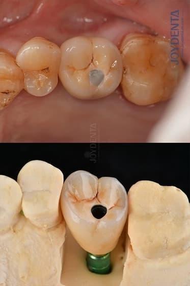 Titanium Full Arch Dental Implants Prosthetic Platform 4.1mm For Exceptional