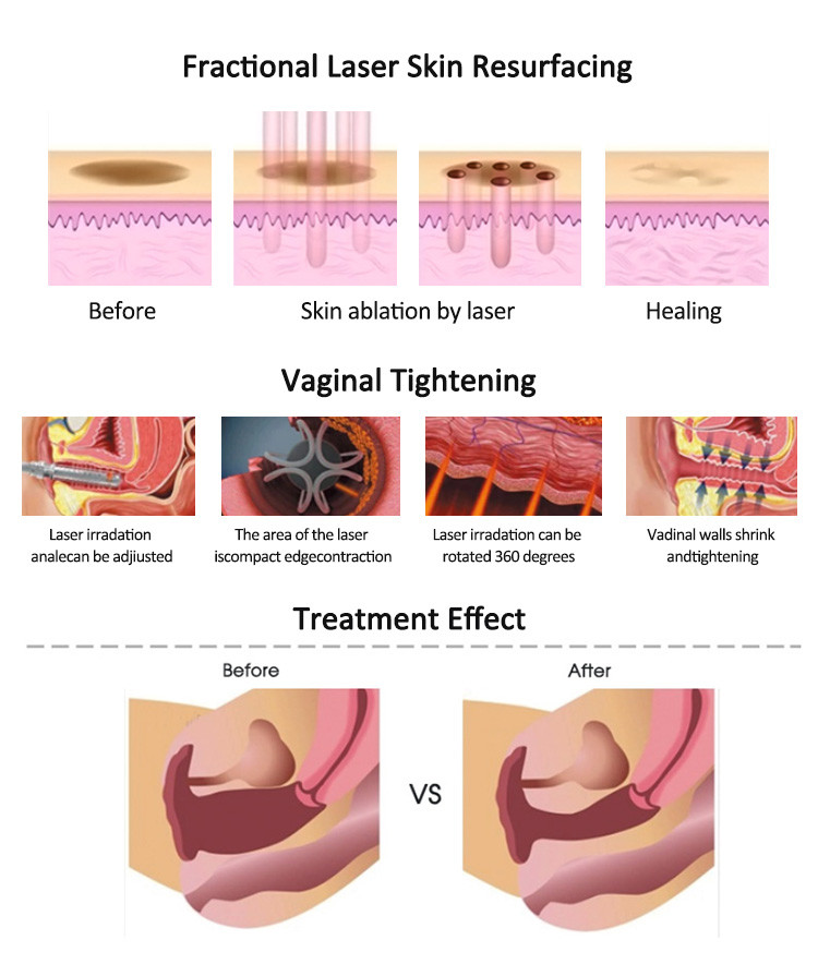 10600nm CO2 Fractional Laser Machine With 7 Joints Arm Scar / Wrinkle Removal Vaginal Treatment