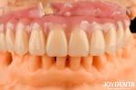 Dental Treatment High Elasticity Acrylic False Teeth Finish For Tooth Arrangemen