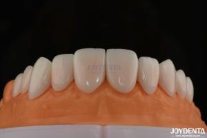 China A1-A4 Ips Emax Press Porcelain Dental Veneers Stain Resistant Customizable Shape factory