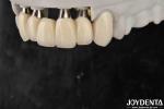 Customizable Implant Crown And Bridge For Safe Oral Biocompatibility