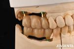 4.5mm Height Polished Internal Hex Dental Implant Abutments V Shape Screw