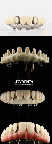 Dental Aesthetic Titanium Malong Hybrid Bridge Ultimate Solution For Dental