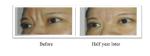 350mg 150mg PLLA Poly L Lactic Acid Dermal Filler For Facial Wrinkles Treatment