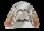 Metal Base and Acrylic Resin Partial Removable Denture for a Secure Fit and