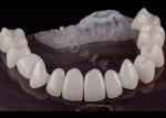 Translucent Dental Tooth Solid Zirconia Crown Natural Aesthetics Chipping