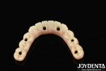 Custom-made Ti-Bar Zirconia Hybrid Bridge For Comfort And Durability In Dental