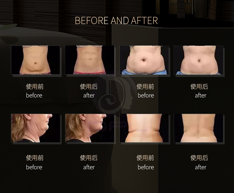 AS86 Portable 80K Cavitation Rf Vacuum Slimming Machine Body Shaping