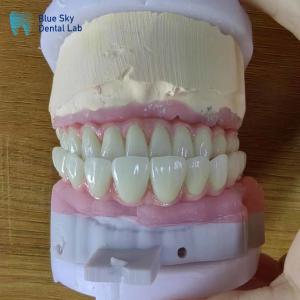China Artificial Full Arch Dental Implants Operation Cases For Surgical Procedures factory