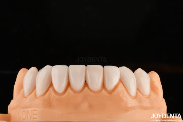 Strong Bond With Tooth Enamel For Secure Fit Dental Veneers Customization For