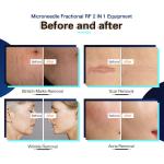 CE FDA Fractional Rf Microneedling Machine Thermage Skin Rejuvenation Wrinkle
