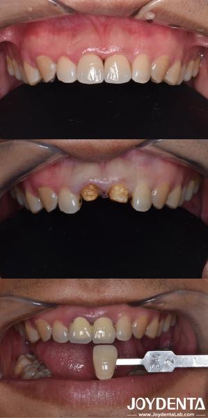 Biologically Oriented Preparation Technique Dental vertical Preparation