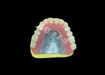 Cast Partial Dentures Crafted for Durability Comfort and Aesthetic and Lasts