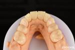 Biocompatible PMMA M75 Restoration Scratch Resistant For Dental Aesthetics