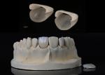 Custom Made Dental Restoration EMAX Veneers Beautifully Aligned Digital