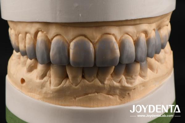 Natural Color Dental Wax Up Versatile Solution for Single or Multiple Teeth