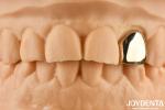 Experience Oral Rehabilitation Like Never Before With Gold Crown Wax Casting