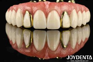 China Experience The Durability Of Titanium Malong Hybrid Bridge For Applicable Dentistry factory