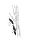 Orthopedic Wrist External Fixator Standard Single sided Integrated