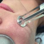 Portable 15w Co2 Fractional Acne Surgical Scar Laser Machine