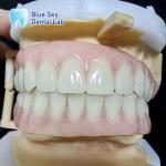 Bluesky Temporary Acrylic Partial Denture Full Upper And Lower Acrylic Denture