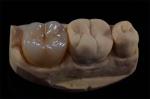 Minimally Invasive Zirconia Crown for Natural Smile Design