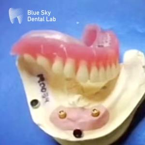 China Titanium Dental Locator With Removable Denture And Ball Cap Attachments factory