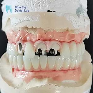 China Titanium Malo Bridge Implant Bridge Without Multi Unit Abutment Cementable factory