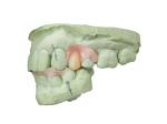 Invisible Denture Base Resin For Fast Production And Partially Edentulous