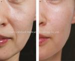 PCL Polycaprolactone Hyaluronic Acid Filler Medical Beauty Injection Collagen
