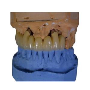 China FDA PFM Crown Porcelain fused to Metal Crown factory