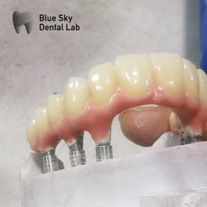 China Nature Shape Full Arch Implant Cases Smooth Surface Dental Implant Case factory