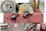 980 spider removal vascular laser vein vascular lesions removal diode laser