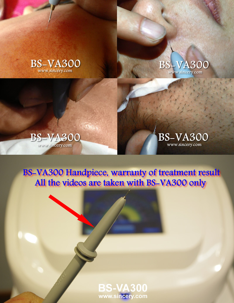 HF Leg Spider Vein / Skin Tag Removal Laser Machine With 0.005mm Tip Diameter