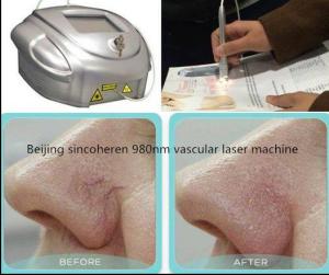 China Portable Mini 980nm Diode Vascular Removal Machine , Spider Vein Removal Machine factory