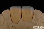 Long Lasting Dental Feldspathic Veneer Natural Tooth Color Translucent