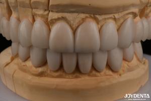 China 0.3mm Thickness Ips Emax Veneers Ceramic Veneers Anterior Posterior Restorations factory