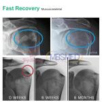 180hz Frequency Shockwave Therapy Machine Effective Treatment For Erectile