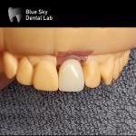 Regular Implant Cases Universal Compatibility Dental Implant Case