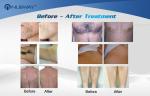 Doide laser hair removal machine