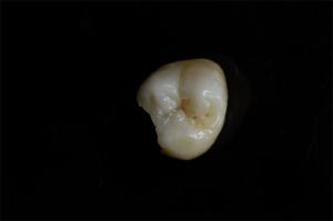 China Customizable Ceramic Inlays And Onlays In Dentistry Restoration factory
