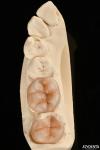 Natural Looking Composite Inlay Onlay Dental Restoration With Natural Appearance